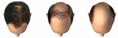 How to start minoxidil treatment male baldness (alopecia)? 3 Alopecia Androgenetic minoxidil
