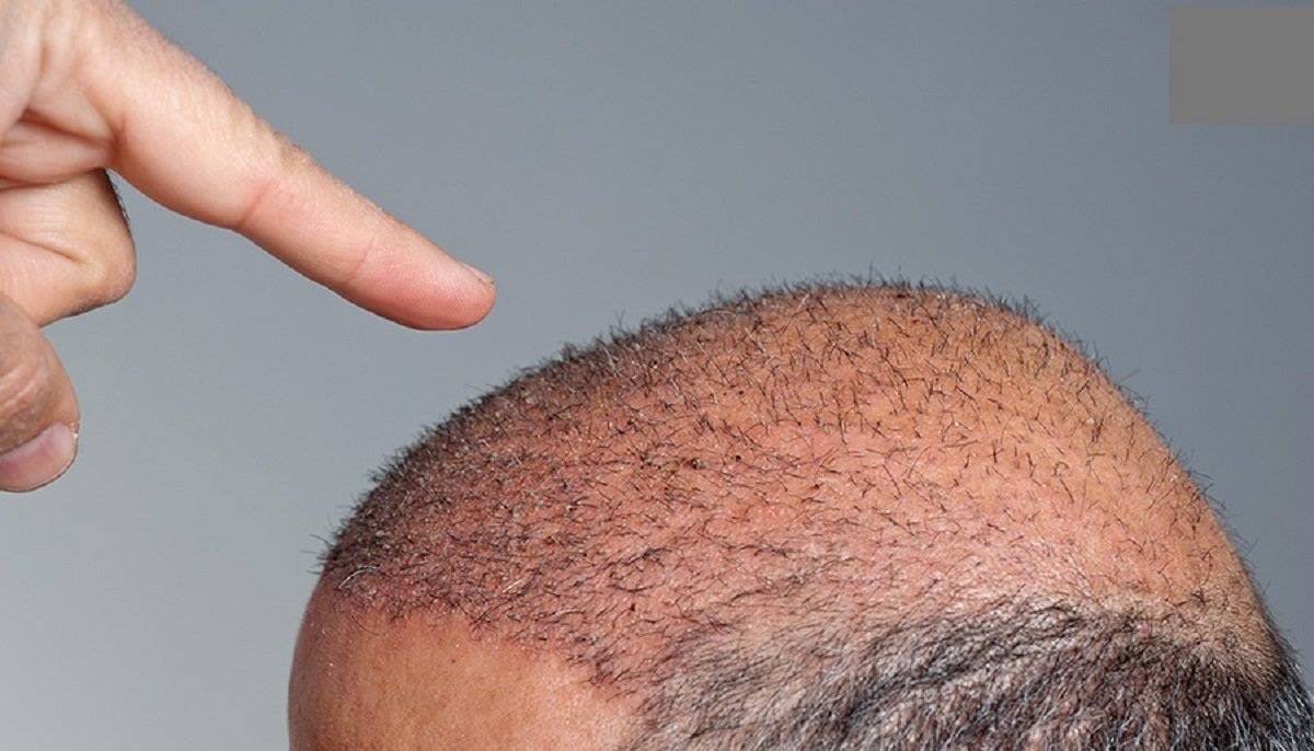 How to start minoxidil treatment for male baldness