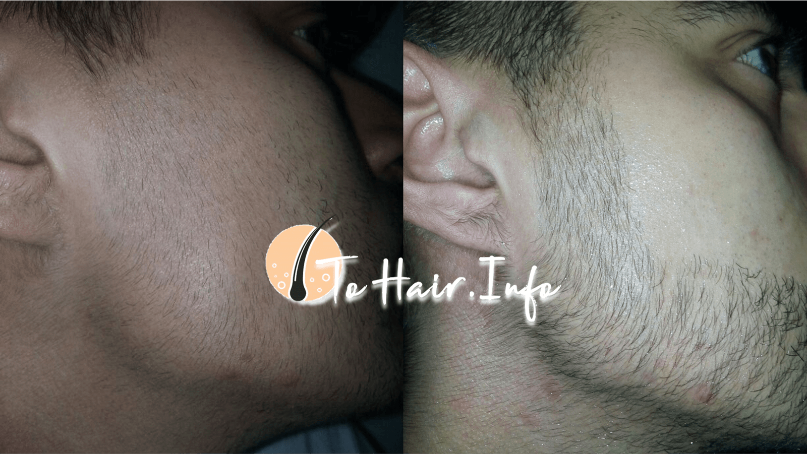 Minoxidil to grow beard.