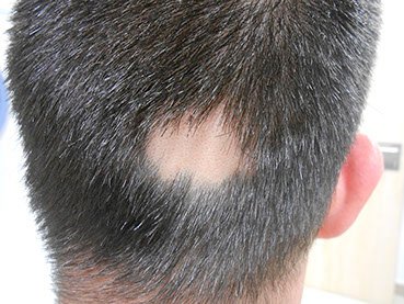 How to start minoxidil treatment male baldness (alopecia)? 2 How to start minoxidil treatment for male baldness?