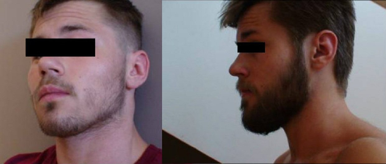 How long to use minoxidil for beard growth