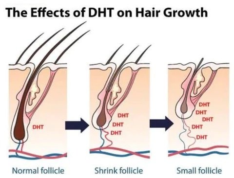 dht and hair loss  Is minoxidil for beard permanent