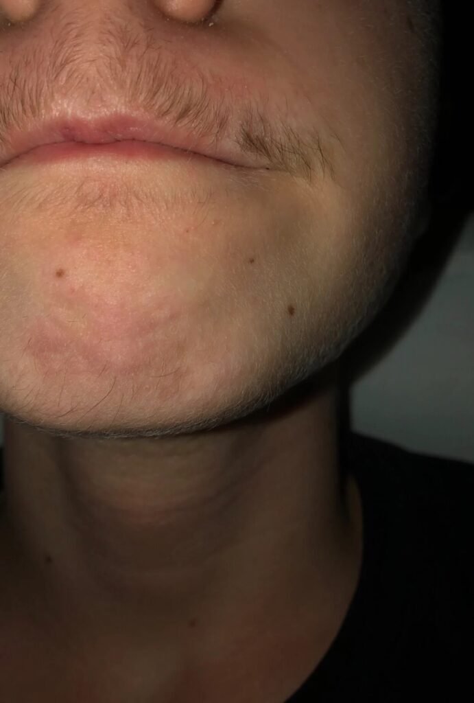 4 reasons why minoxidil doesn't work for your beard 2 reasons why minoxidil doesn't work for your beard