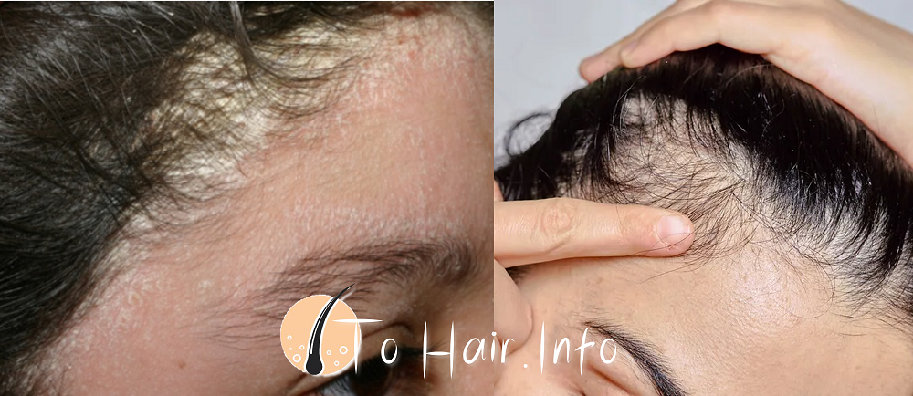 Rosemary oil for hair growth 5 Rosemary oil for hair growth